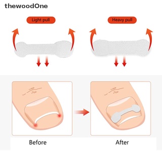 [thewoodOne] 10Pcs Ingrown Toe Nail Correction Sticker Patch Paronychia Corrector Treatment .