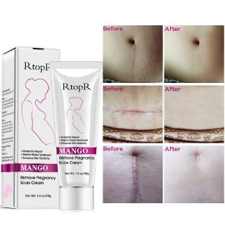 RtopR mango elimina cicatrices de embarazo, crema para acné, tratamiento de marcas de estiramiento, reparación de mujeres embarazadas, antienvejecimiento, endurecimiento de la piel y cuerpo (1)