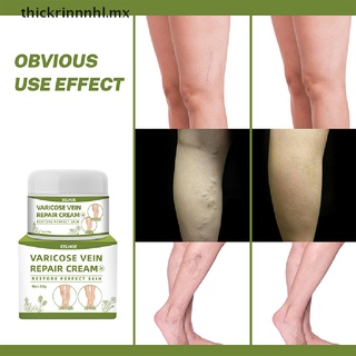 [newwwwww] Spider Leg Gel Effective Varicose Vein Repair Cream for Postpartum Obese People [thickrinnnhl] (1)