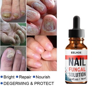 10ml/pc Tratamiento De Uñas Eliminar El Hongo Onicomicosis En Los Dedos De Las Hongos Antifúngico Cuidado