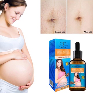 Aceite esencial Para el cuidado De la piel Elástica Para eliminar embarazo/desemplazo/desemplazo (1)