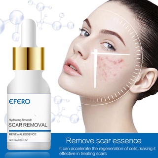 Esencia Facial Anti-acné Ácido hialurónico tratamiento Para blanqueamiento y acné