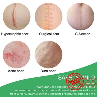 4 unids/pack de pegatinas de cicatriz médica de silicona gel tiras de tratamiento aliver away skin patch cinta scar v6z8