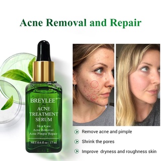 crema removedora de acné para eliminar acné y espinillas/control de aceite