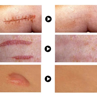 Crema depilatoria De 30 g Para cicatrices/crema Facial removedora De cicatrices