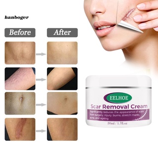 Han_ absorbe rápidamente crema cicatrizante acné crema eliminación de cicatrices prevenir enrojecimiento para estrías Gravidarum (3)
