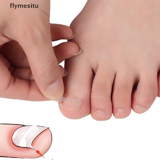 fesi 10 pzs parche corrector de uñas encarnado del dedo del pie parche tratamiento corrector paroniquia.