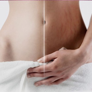 Estrías y estrías removedor de estrías maternidad piel crema de reparación corporal (6)